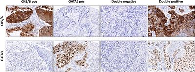 CK5/6 and GATA3 Defined Phenotypes of Muscle-Invasive Bladder Cancer: Impact in Adjuvant Chemotherapy and Molecular Subtyping of Negative Cases